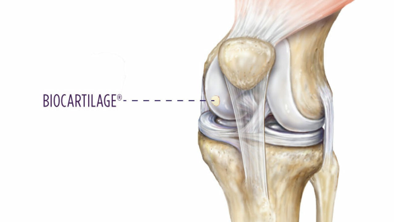Лечение хряща коленного сустава | лечение травм и заболеваний коленного и плечевого сустава