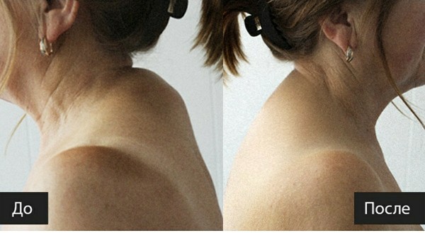 Новая процедура: избавление от "холки" ("вдовий горбик") на шее - врач-косметолог частный кабинет г. рошаль, шатура