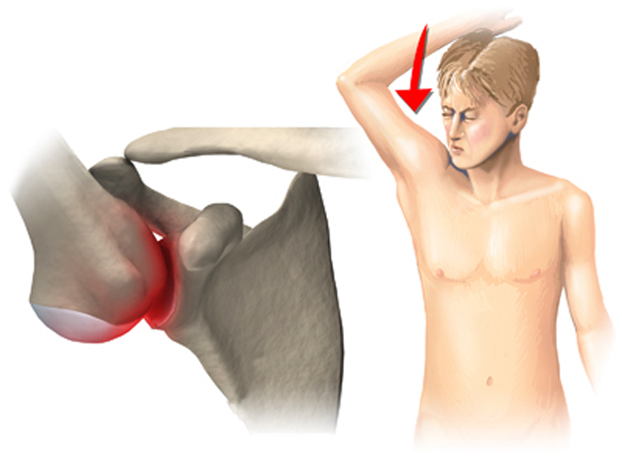Что такое "синдром щелкающего плеча" - нолтрекс.